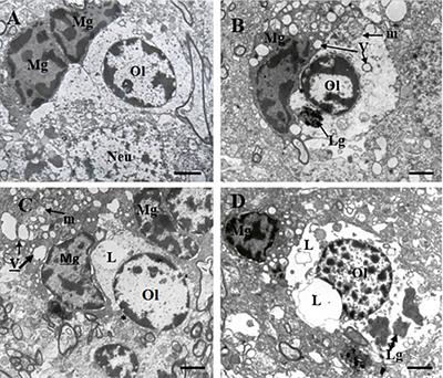 Dystrophy of Oligodendrocytes and Adjacent Microglia in Prefrontal Gray Matter in Schizophrenia